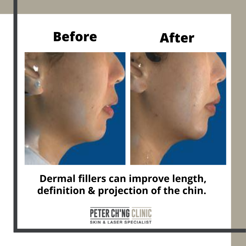 Patient Mailbox: Reshaping A Flat Facial Profile Non-Surgically With Fillers | Peter Ch'ng Skin